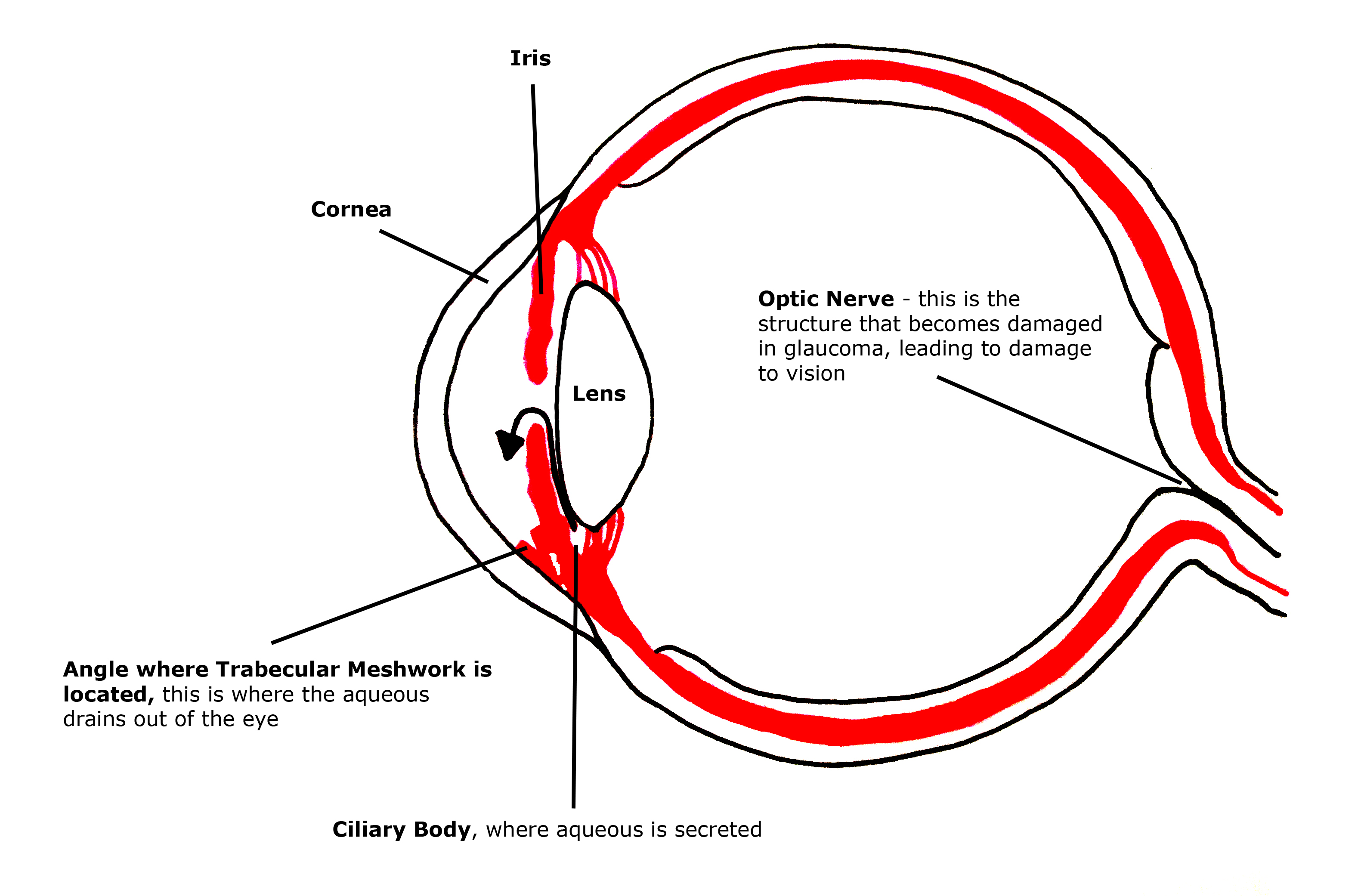 Glaucoma Diagram