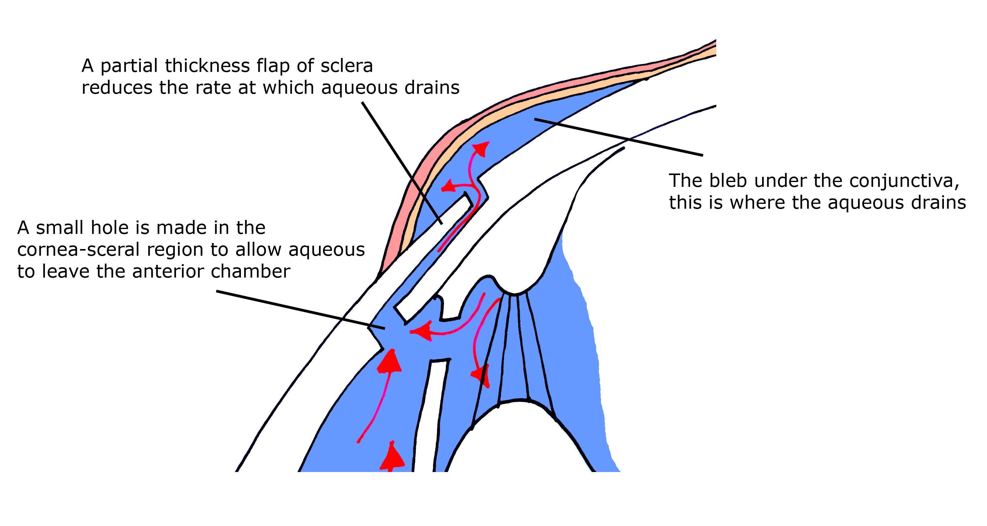 Trabeculectomy Diagram